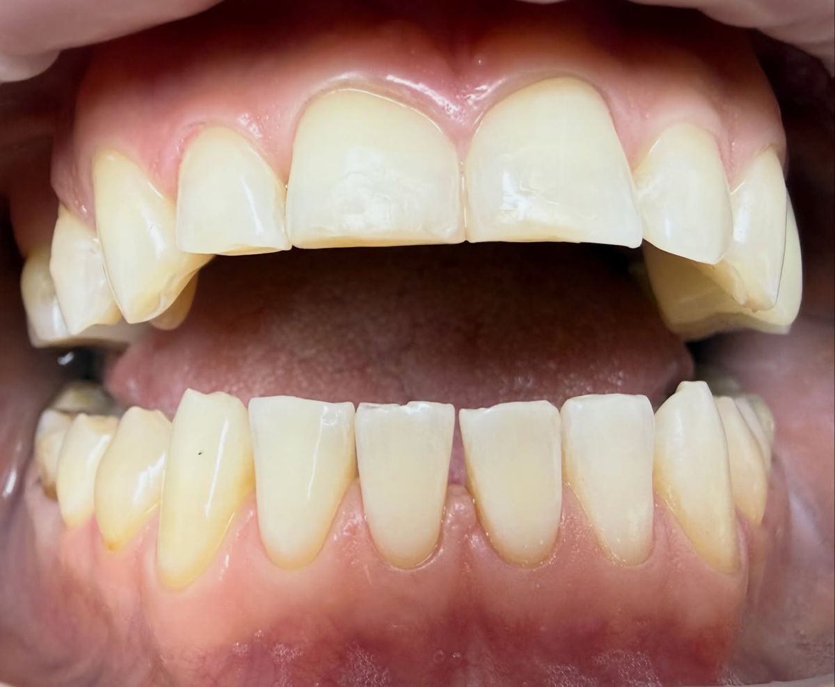 Ті самі зуби після відбілювання Magic Smile
